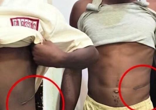 ‘I Was Shocked’: Mother Narrates How She Discovered Her Son’s Kidney Had Been Removed